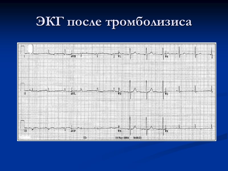 ЭКГ после тромболизиса